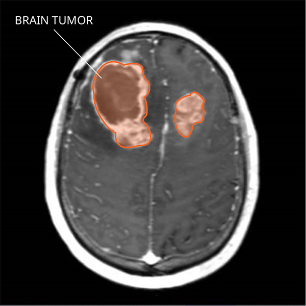 stage-4-brain-cancer-life-expectancy-canceroz